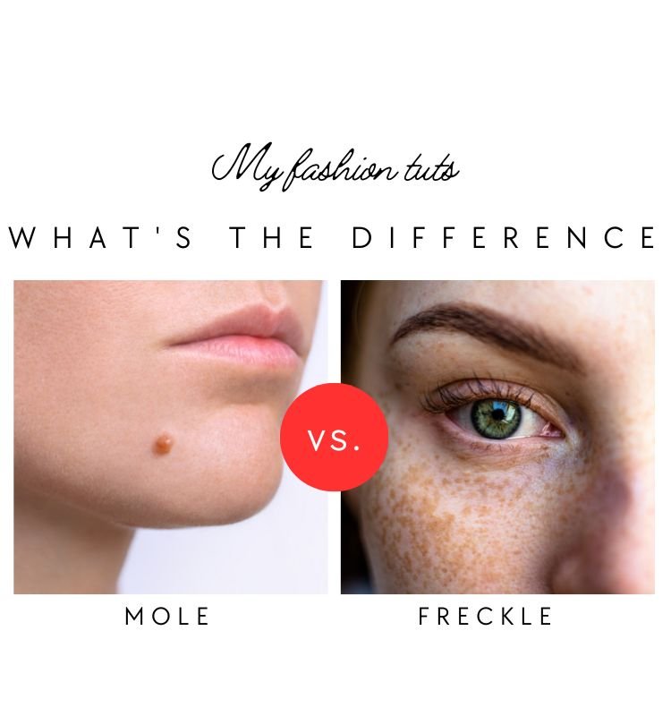 Mole vs Freckle